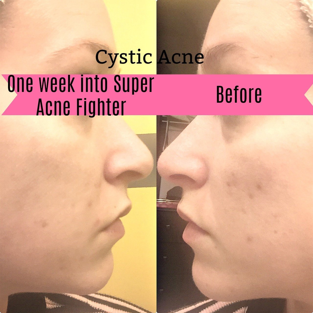 Super Acne Fighter / Organic Acne Treatment / Acne / Essential Oils /